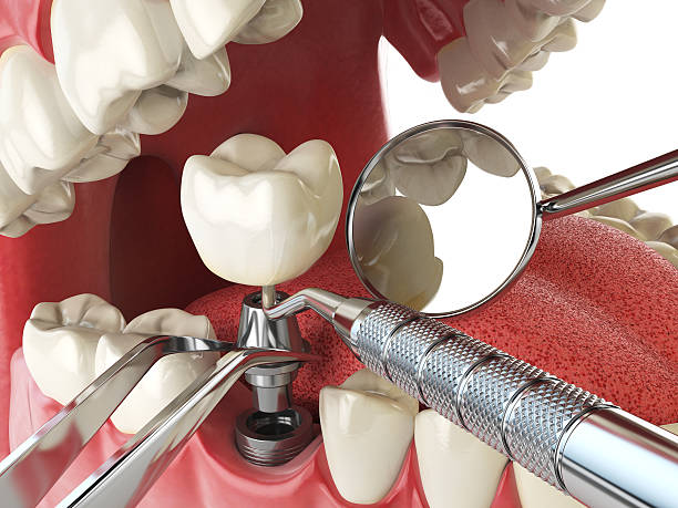 Best Emergency Root Canal Treatment in Gibsonburg, OH